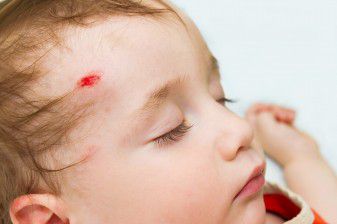 Falls Are Top Cause of Head Trauma in Children