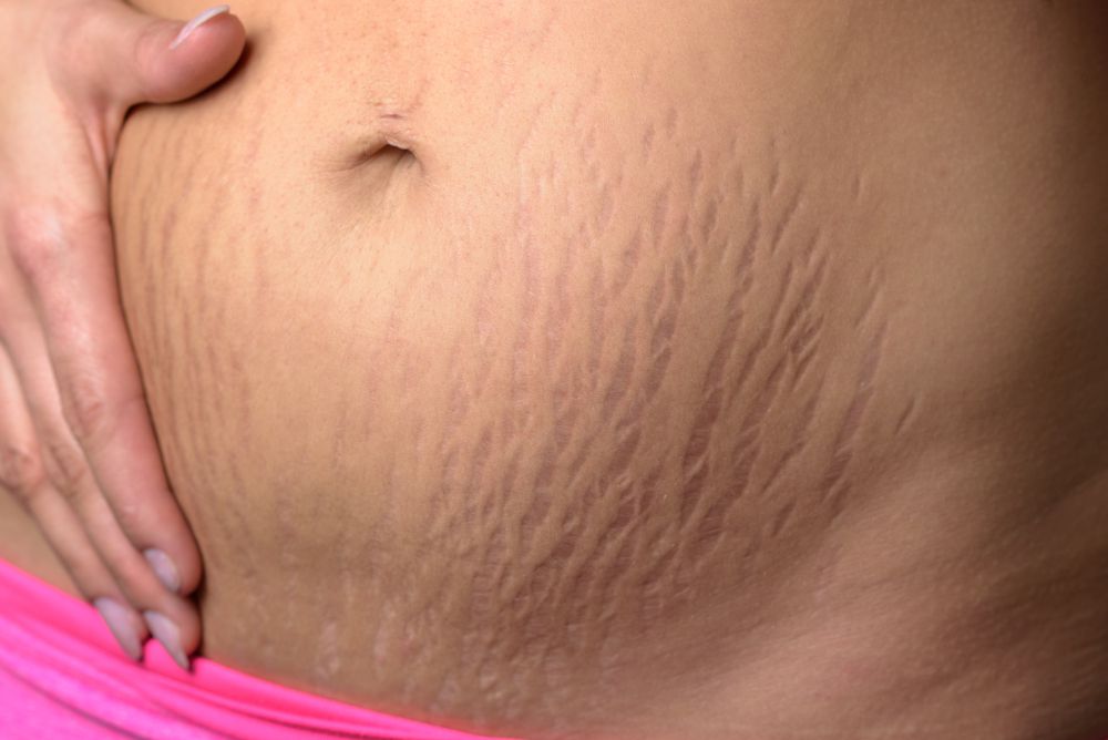 Image result for pregnancy stretchmarks
