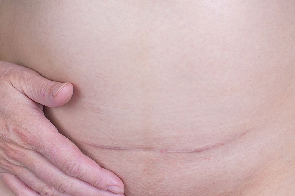 closeup of C-section scar
