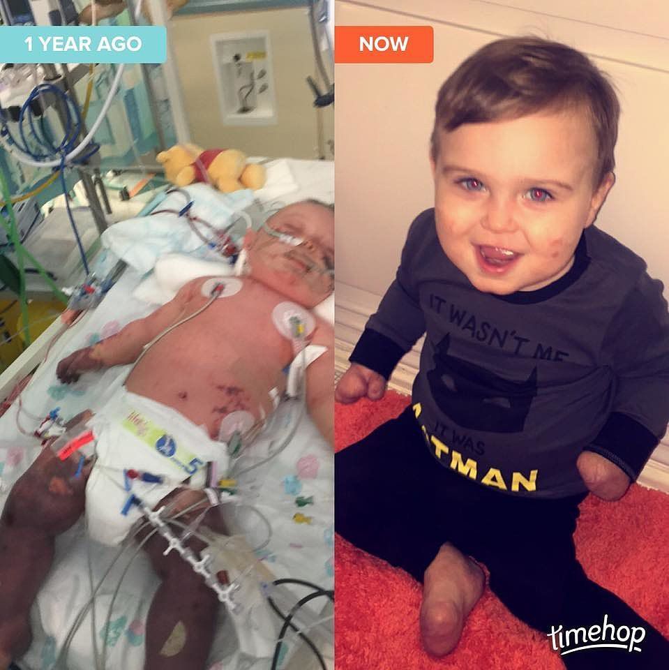 Baby boy with meningitis survived but needed amputations.