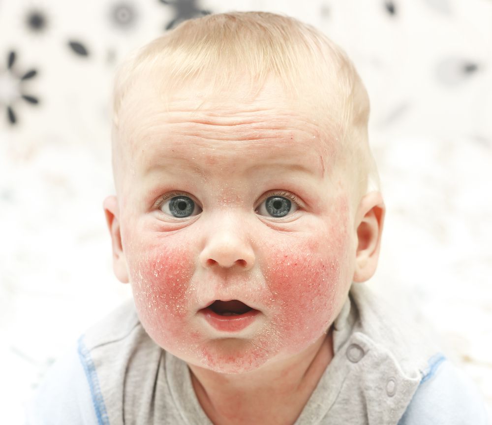 Does Your Baby Have Eczema The Water In Your Home Could Be To Blame Parents
