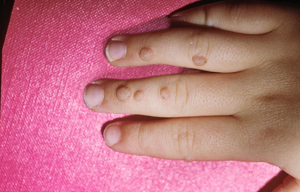 Gross Conditions Warts
