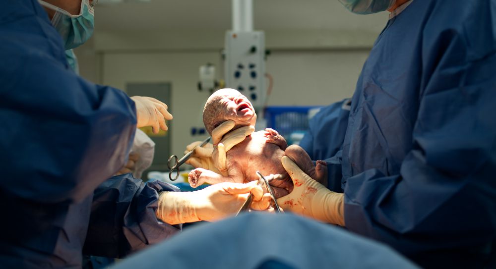 c-section delivery