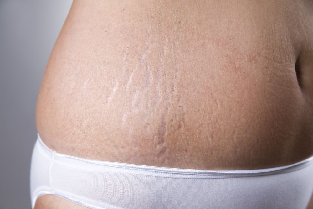 Stretch Mark Removal Surgery: What New Moms Need to Know | Parents