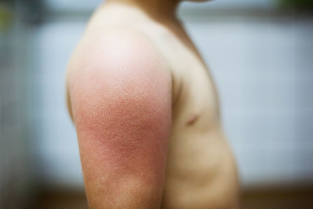 Child with rash on arm
