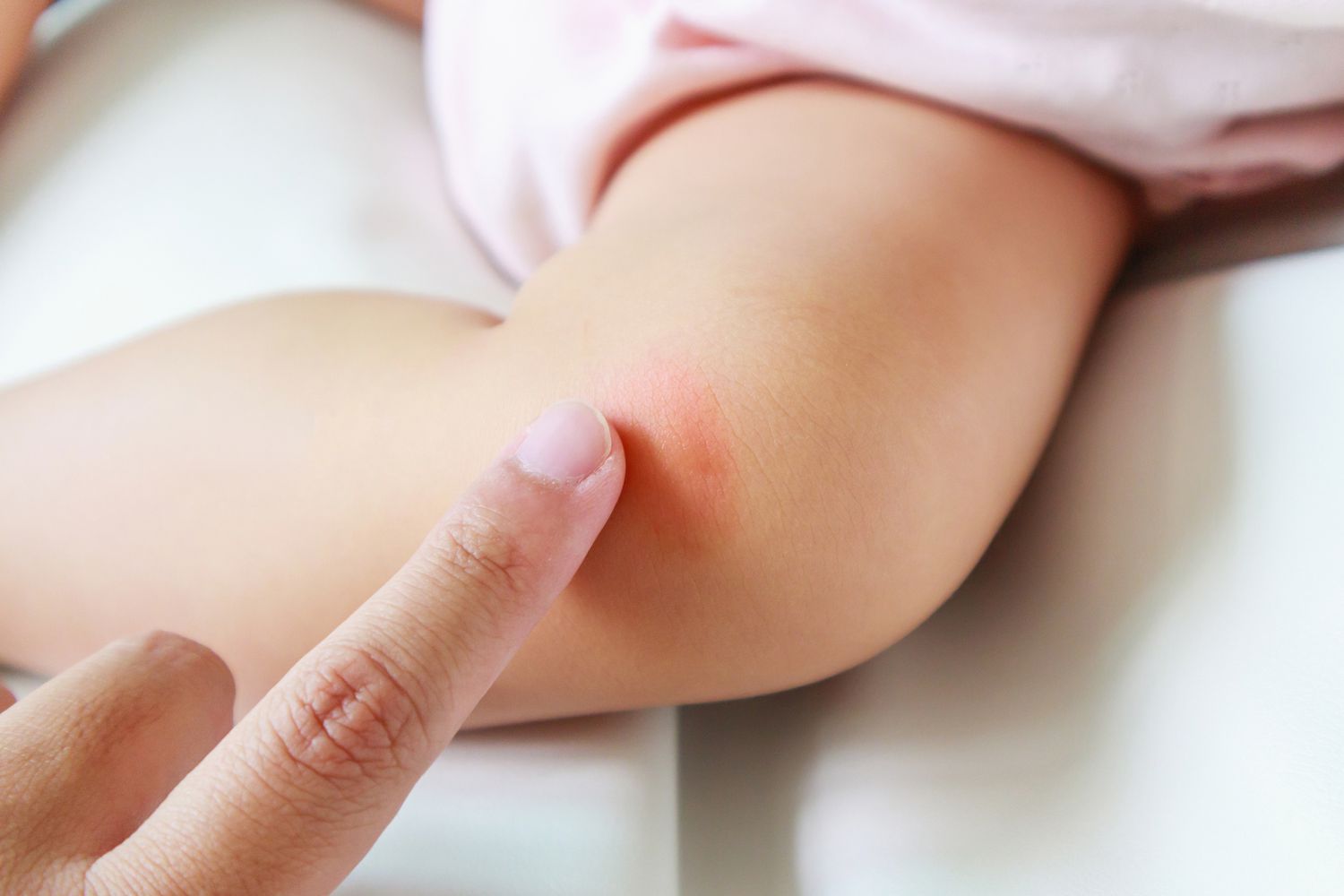 rash on infant