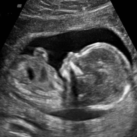 Best date scan at 13 weeks pregnant still not showing 2022