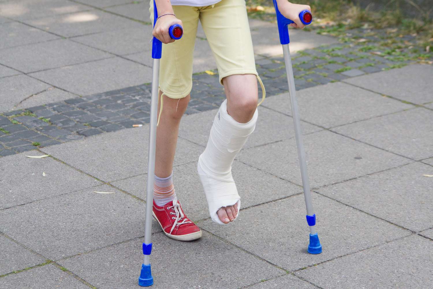 When Your Child Breaks a Bone: Everything You Need to Know About Wearing a  Cast | Parents