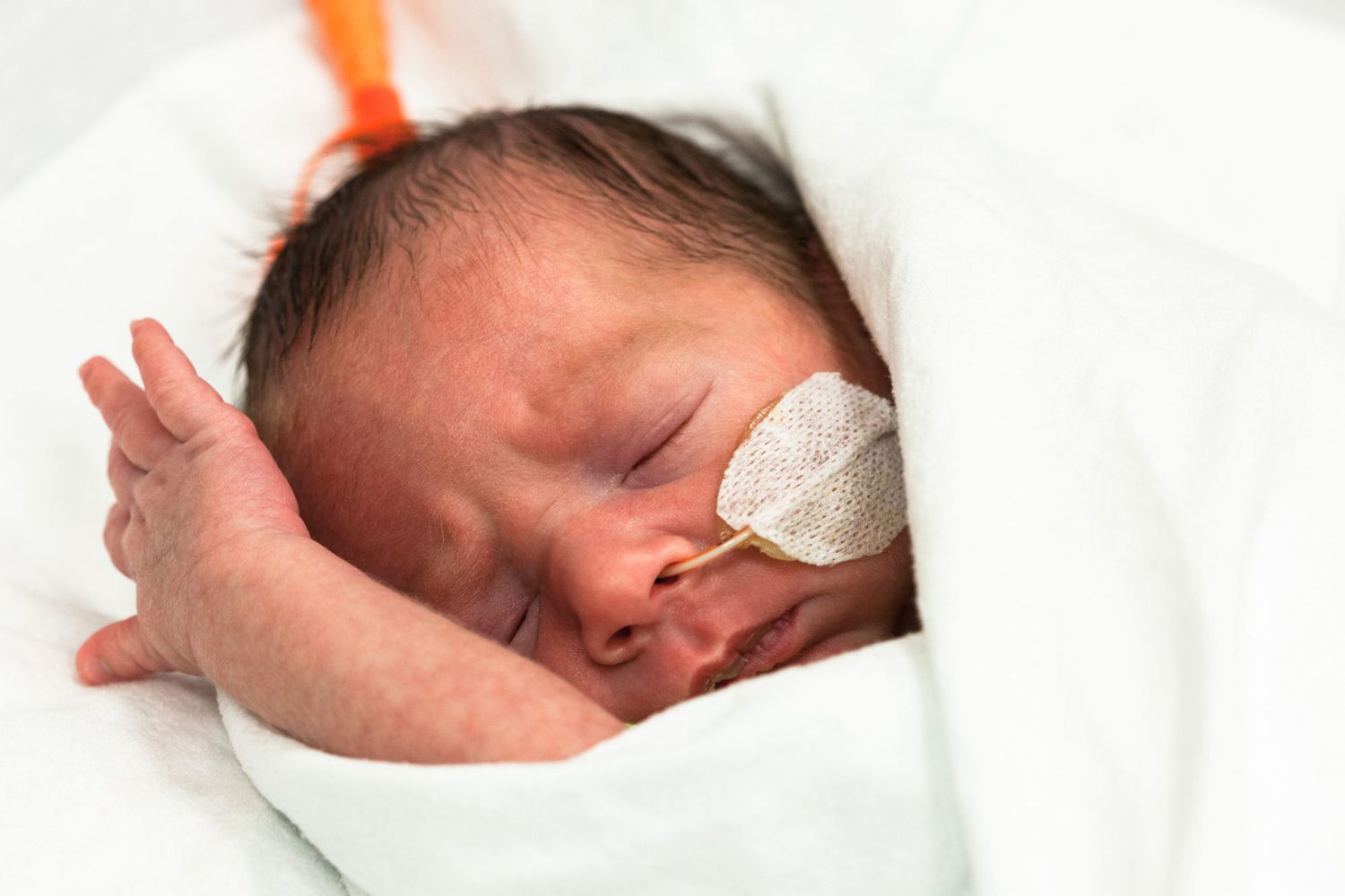 An image of a baby with a feeding tube.