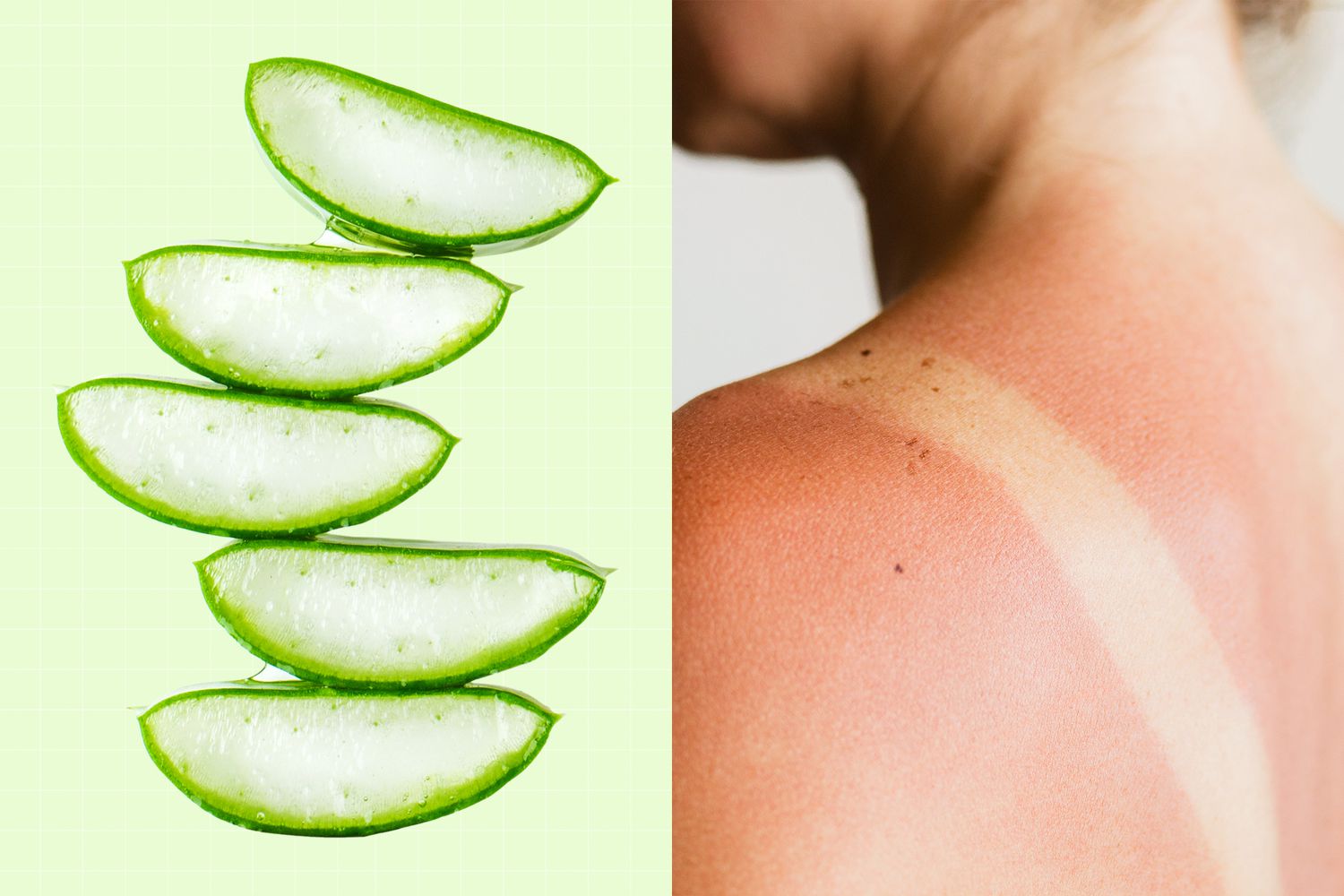 a woman's back with a sunburn next to slices of aloe plant