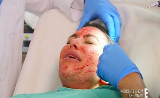 Kim Kardashian Blood Facial