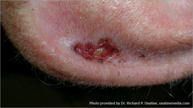 What Does Skin Cancer On The Nose Look Like Pictures Skin Cancers On