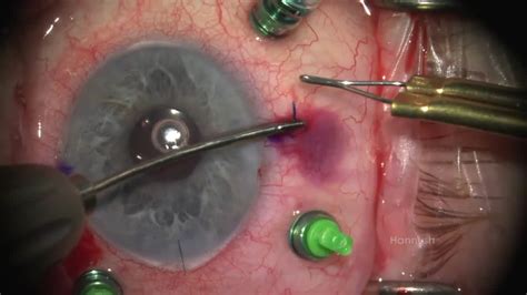 laser cataract surgery pioneer woman
