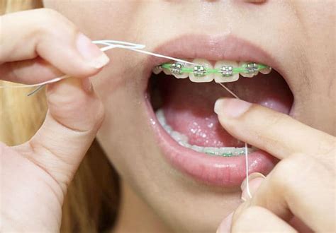 foods to avoid with ceramic braces