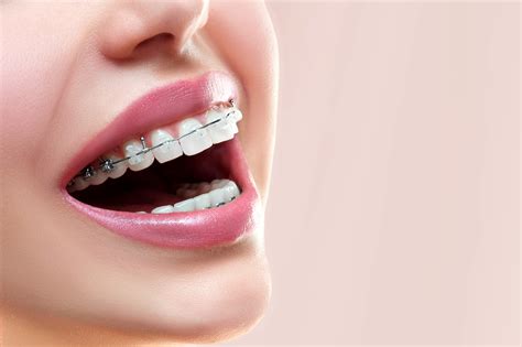 foods to avoid with ceramic braces